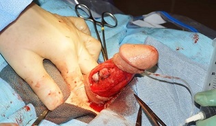 операция за уголемяване на пениса