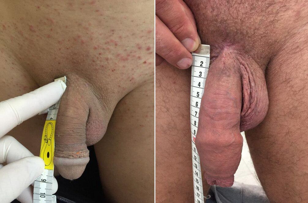 преди и след оперативното уголемяване на пениса